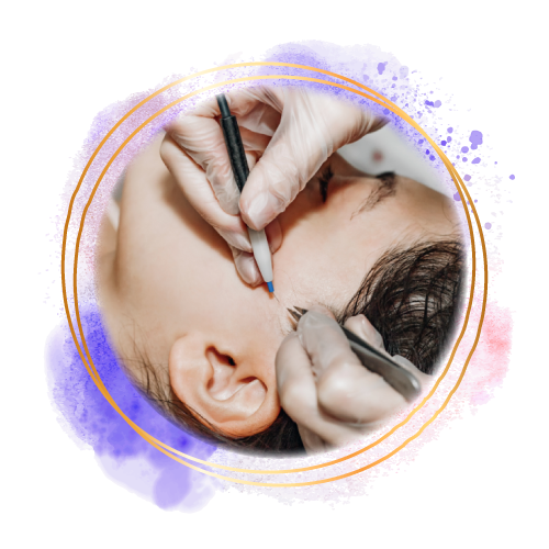 Epilation définitive par électrolyse